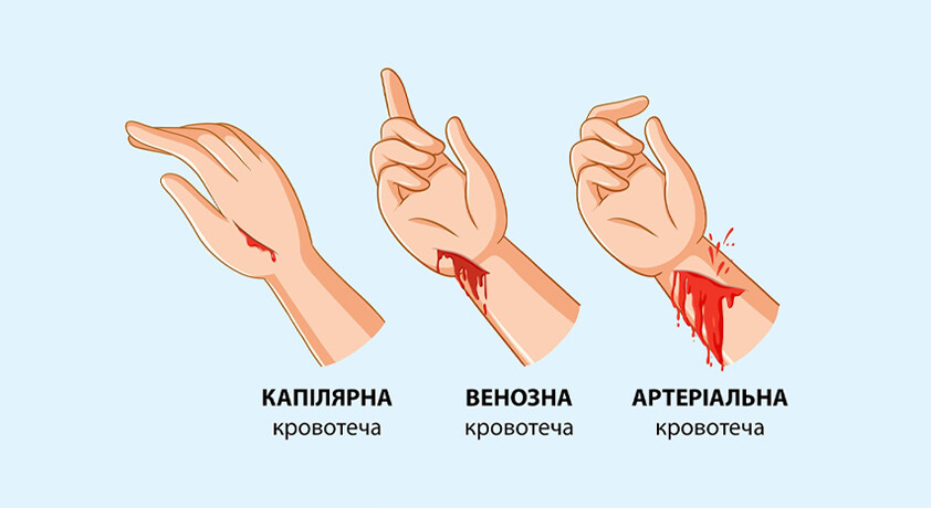 Виды кровотечений, их признаки и первая помощь