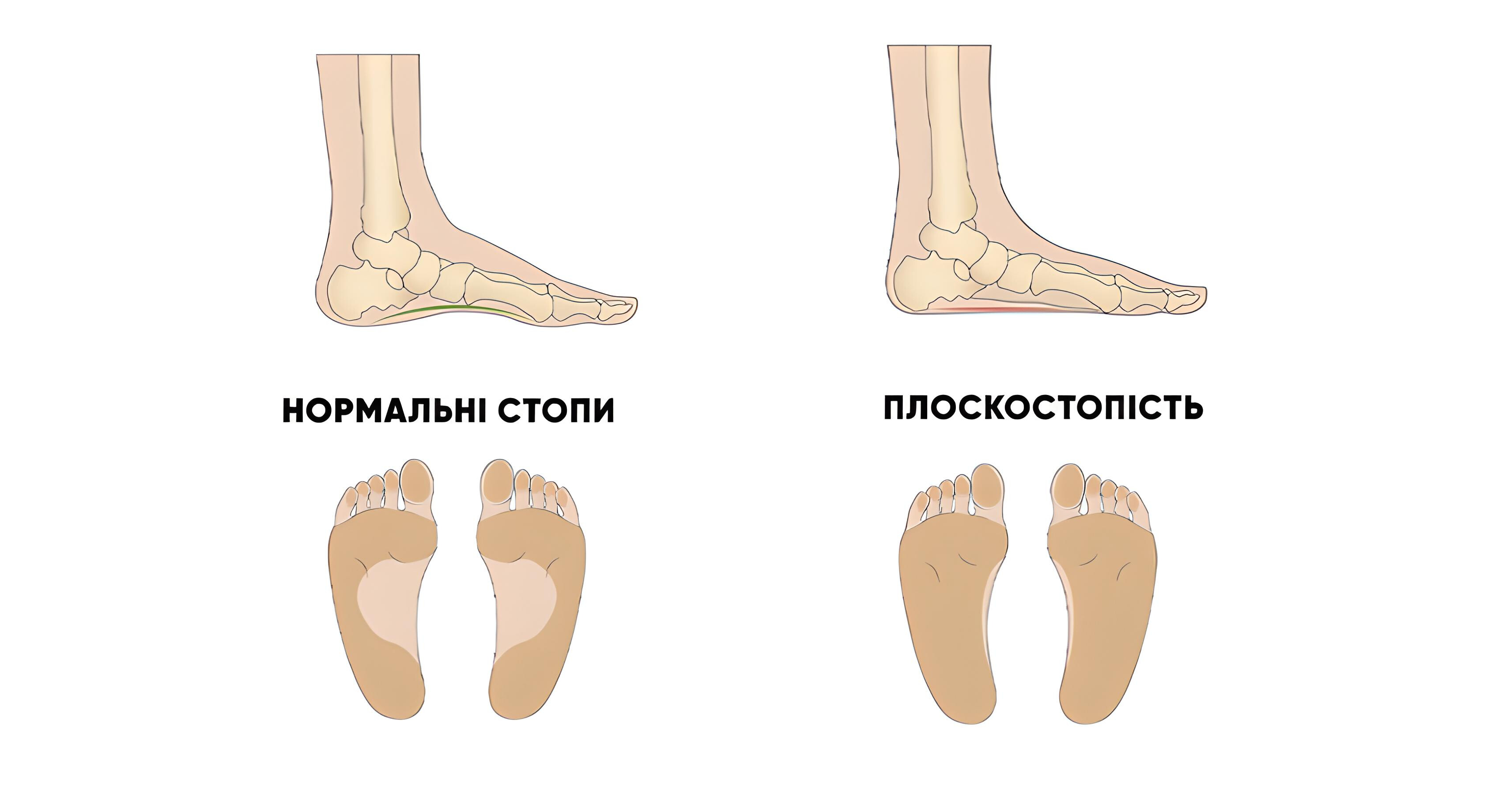 Плоскостопість: що це, чим загрожує і як боротися